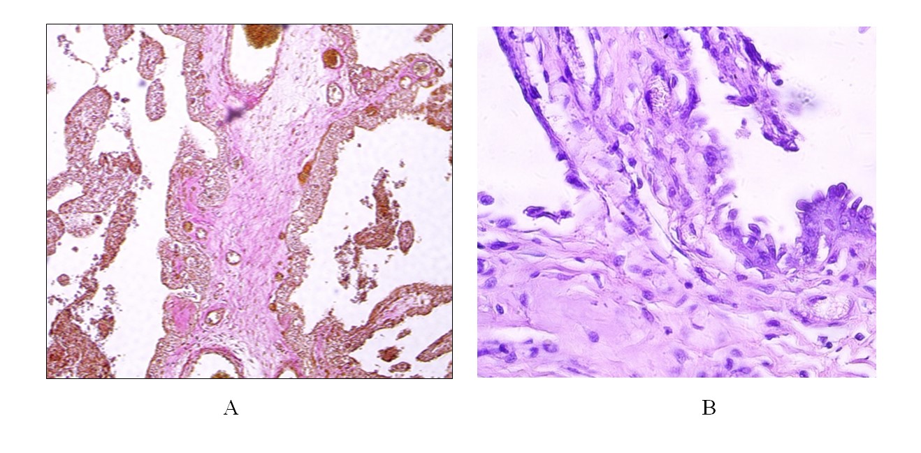 Патоморфологическое исследование плаценты кобылы при преждевременных родах выявило следующие отклонения: а) ворсины хориоаллантоиса подверглись дистрофическим изменениям и некрозу; в) нарушена дифференцировка клеток трофобласта: наблюдается наличие двуядерных клеток на различных стадиях развития, но отсутствуют трехядерные клетки