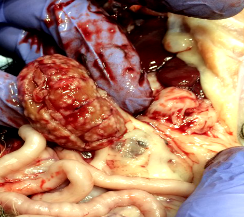 Узлы под фиброзной капсулой почек